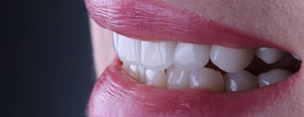 Ultra thin veneers